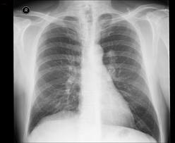 What are the different types of Artificial Intelligence? And how does the media influence how Artificial Intelligence is perceived? - Picture of a chest X-ray